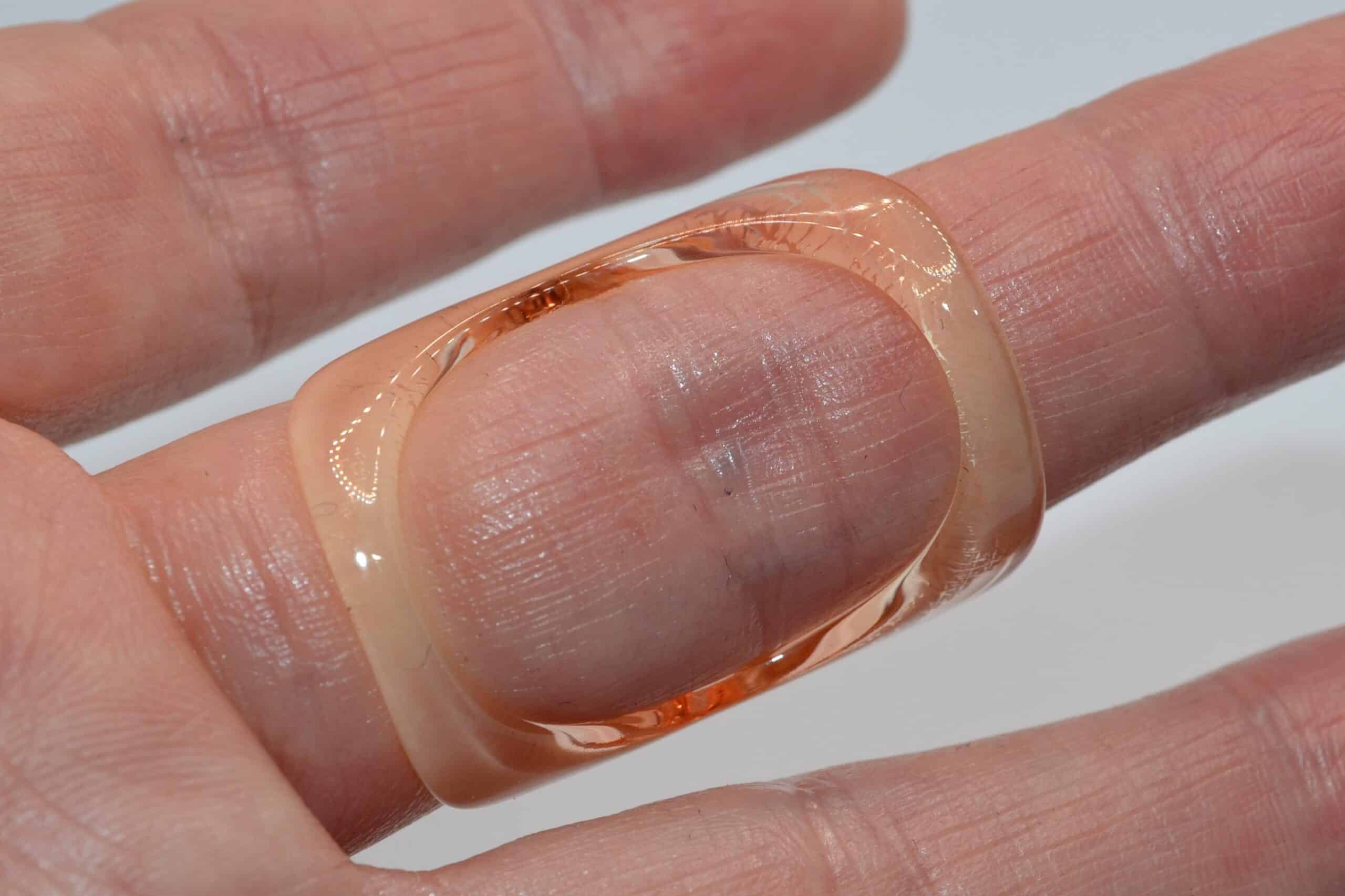 Boutonniere Finger | Boutonniere Deformity Finger Splint